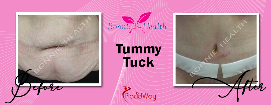 Before & After Tummy Tuck